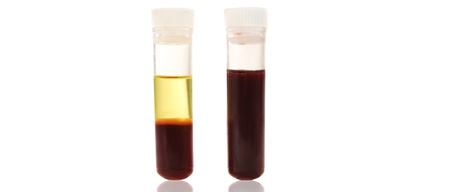 Platelet Rich Plasma ( PRP)